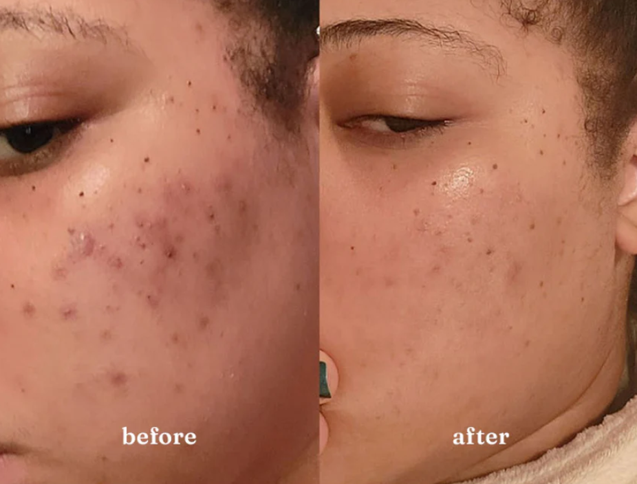 1:1 Clear Skin Strategy Session (Copy)