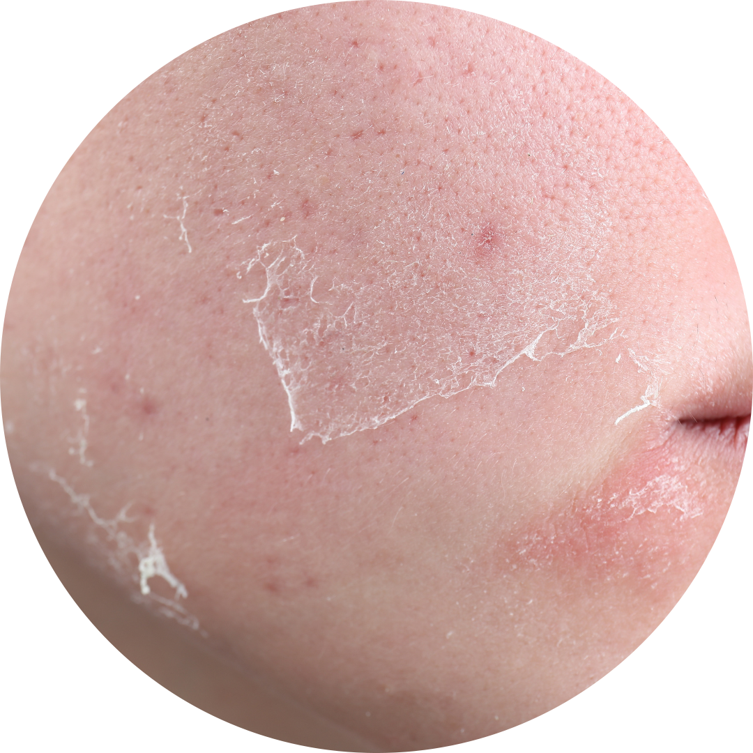 Dry & Dehydrated Skin