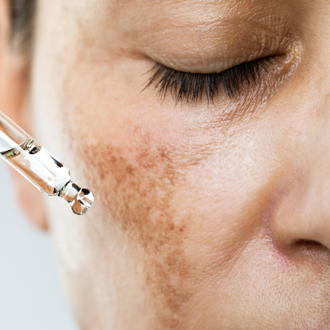 Hyperpigmentation