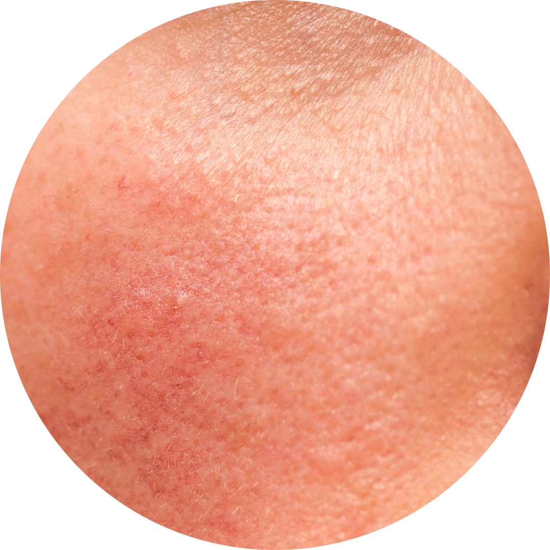 Sensitive Skin