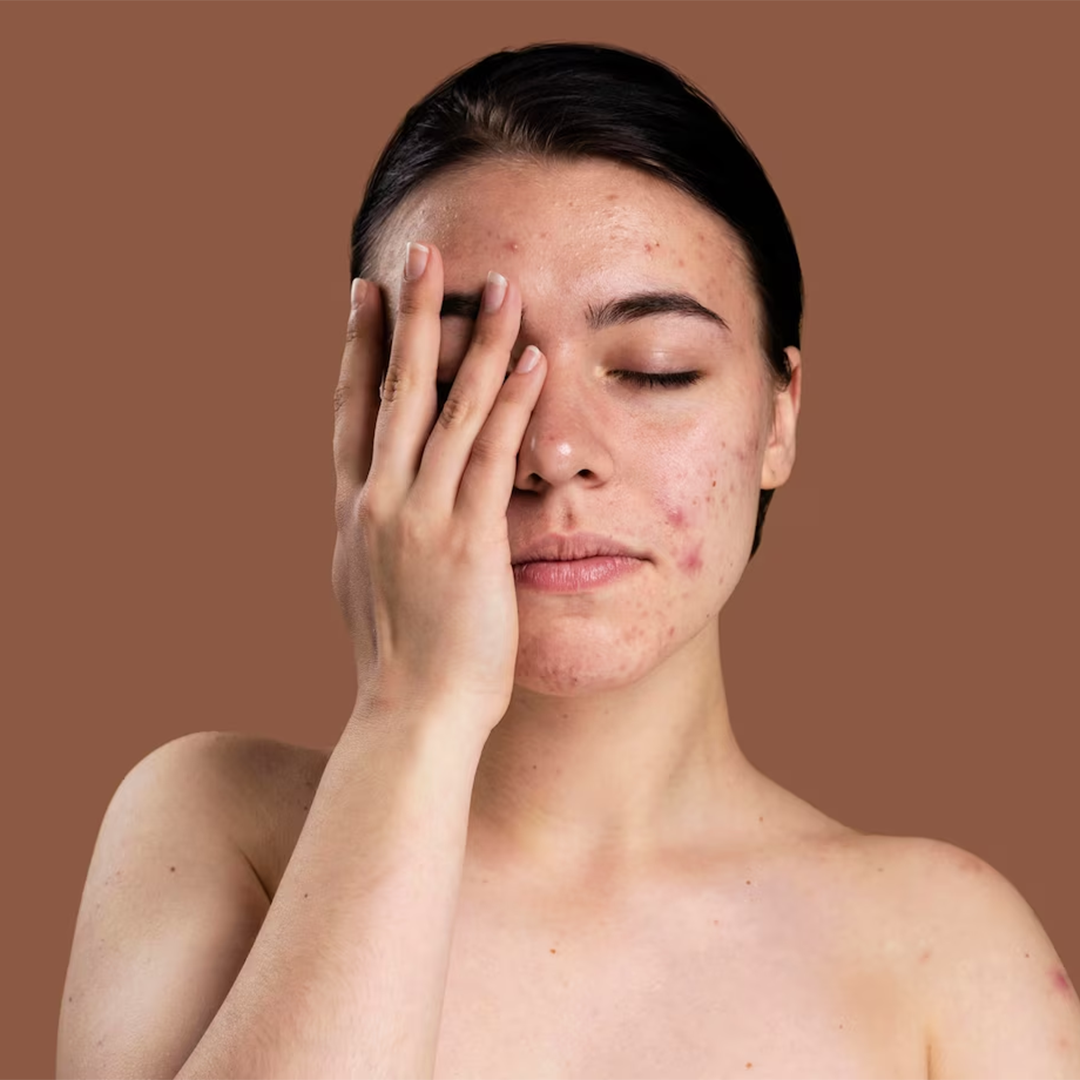 Acne & Blemishes