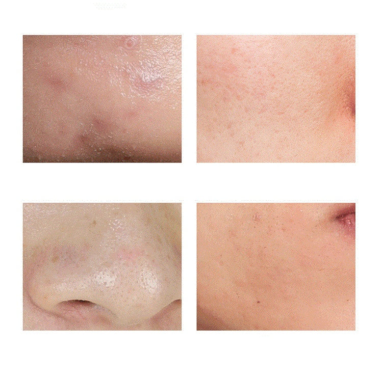 Moisturizing Acne Removing Horse Riding Dew