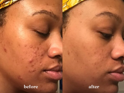 1:1 Clear Skin Strategy Session (Copy)