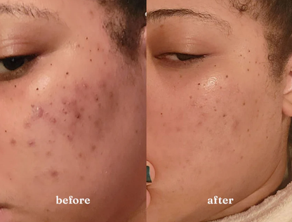 1:1 Clear Skin Strategy Session (Copy)