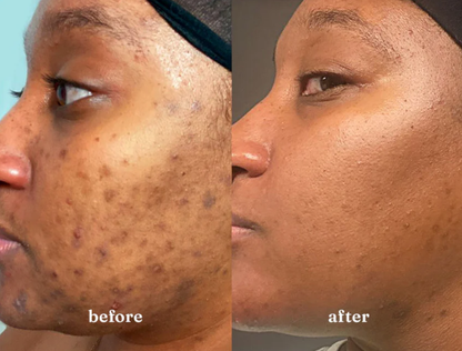 1:1 Clear Skin Strategy Session (Copy)